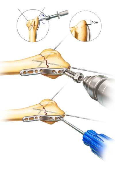 Distal fixation of the Radial Column Peg Plate