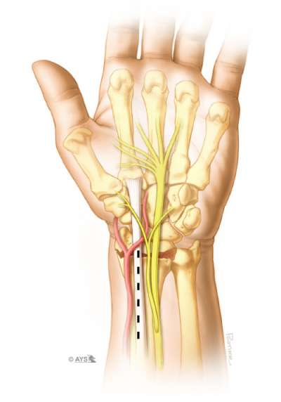 Line along the flexor carpi radialis tendon that indicates where the incision is made