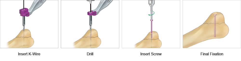 Surgical technique for the cannulated screw system