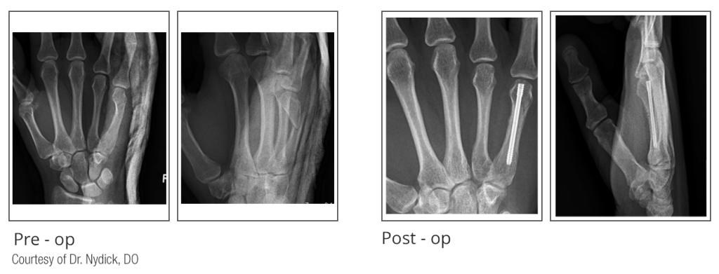 Pre-op and Post-op x-ray comparison